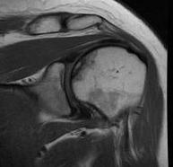 Humeral AVN Stage 2 MRI